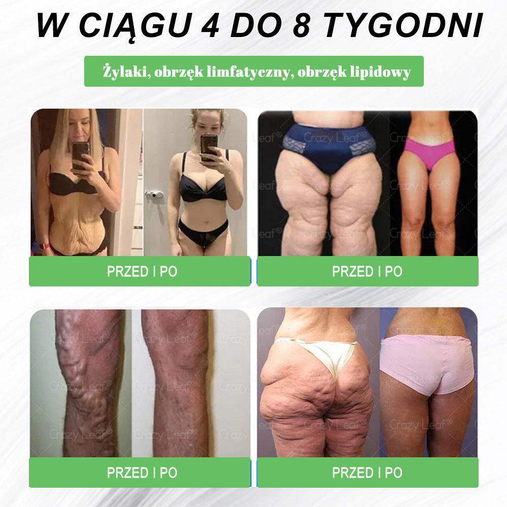 🏥 Klinicznie potwierdzone | CrazyLeaf® SMGT-GLP-1 Slim & Vitality – rozwiązanie doustne na uporczywy tłuszcz, ciśnienie, cukier, stłuszczenie wątroby, ból stawów, zmęczenie, niski poziom energii i zwiotczałą skórę. Lepsze zdrowie, więcej energii!